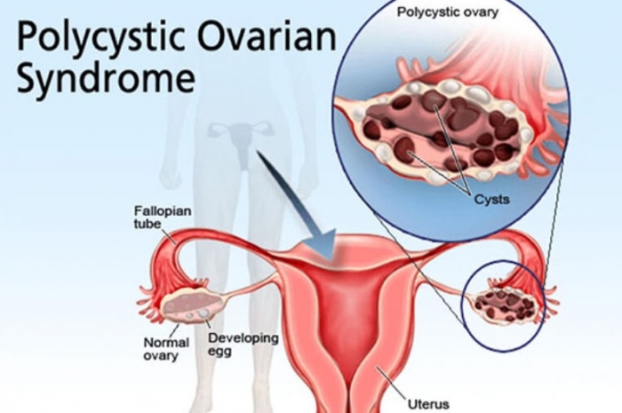 পলিসিস্টিক ওভারি সিন্ড্রোমের কারণ, লক্ষণ ও প্রতিকার