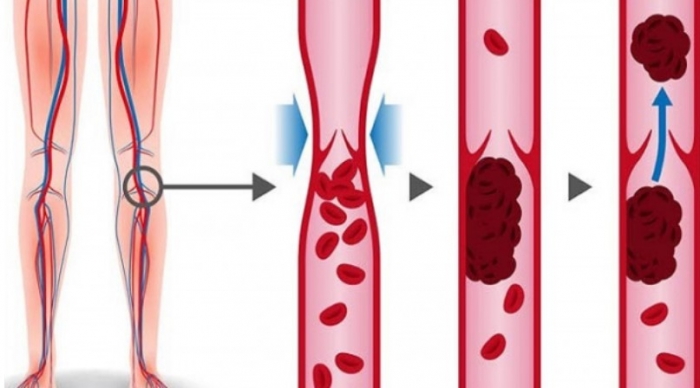 থ্রম্বোসিস কী, এর উপসর্গ ও প্রতিরোধের উপায়