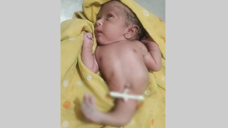 দিনাজপুরে জন্ম নিলো এক পা বিশিষ্ট নবজাতক দিনাজপুরে জন্ম নিলো এক পা বিশিষ্ট নবজাতক